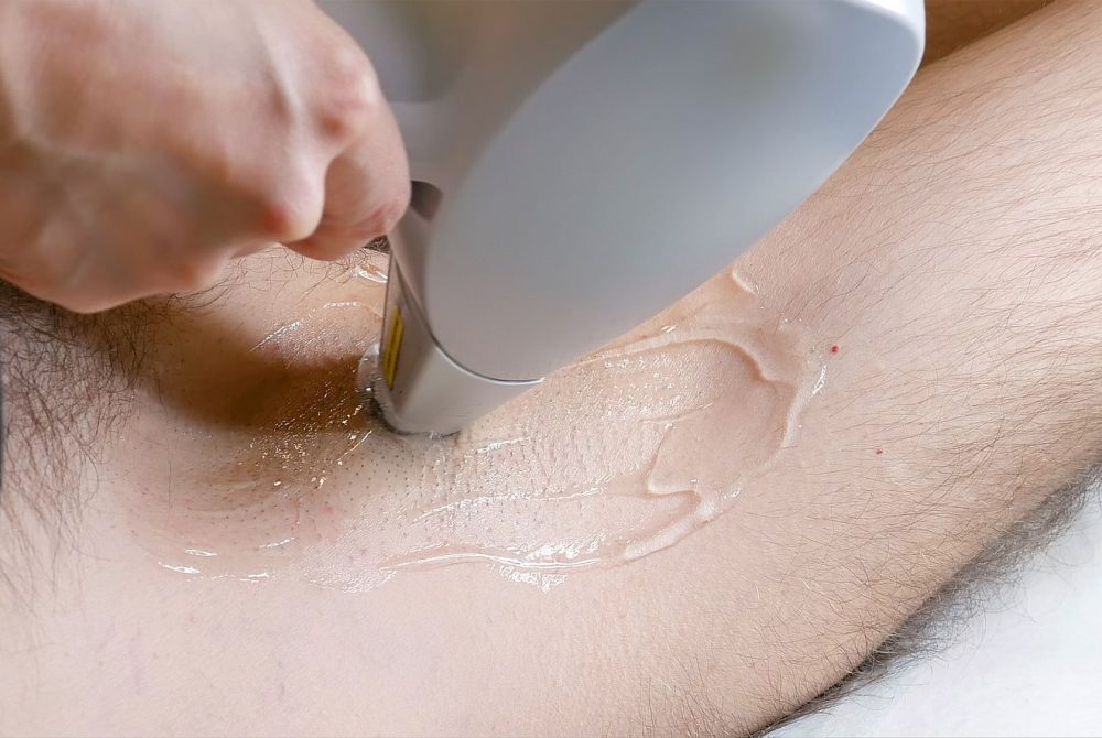 Man gets laser hair removal underarm